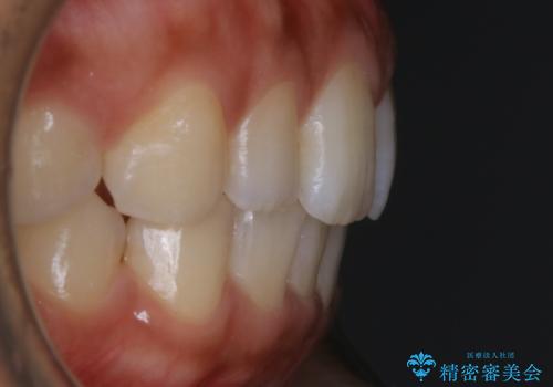 【非抜歯】狭い歯列を改善 ガタつきを治すの治療後