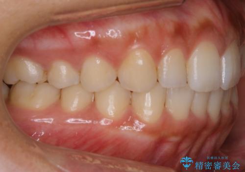 【非抜歯】狭い歯列を改善 ガタつきを治すの治療後
