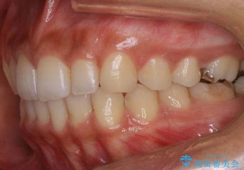【非抜歯】狭い歯列を改善 ガタつきを治すの治療後