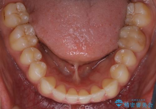 【非抜歯】狭い歯列を改善 ガタつきを治すの治療後