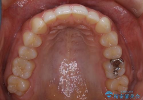 【非抜歯】狭い歯列を改善 ガタつきを治すの治療後