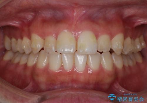 【非抜歯】部分矯正でも治る 前歯の反対咬合の治療中