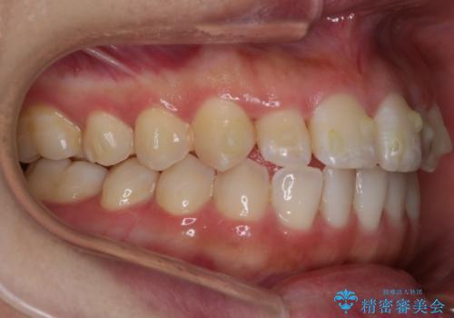 【非抜歯】部分矯正でも治る 前歯の反対咬合の治療中