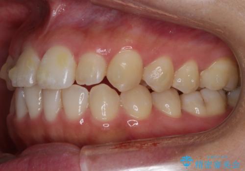 【非抜歯】部分矯正でも治る 前歯の反対咬合の治療中