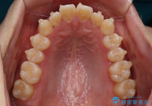 【非抜歯】部分矯正でも治る 前歯の反対咬合の治療中