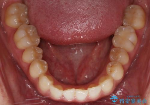 【非抜歯】部分矯正でも治る 前歯の反対咬合の治療中