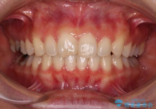 転勤予定がある インビザラインによる矯正治療の治療中