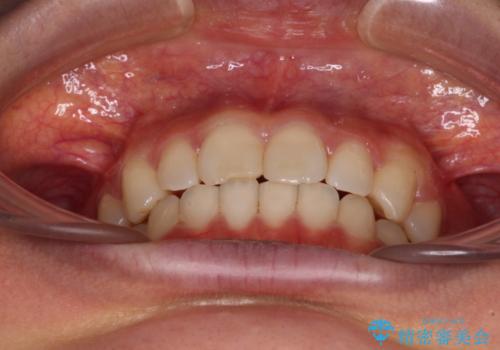 転勤予定がある インビザラインによる矯正治療の治療中