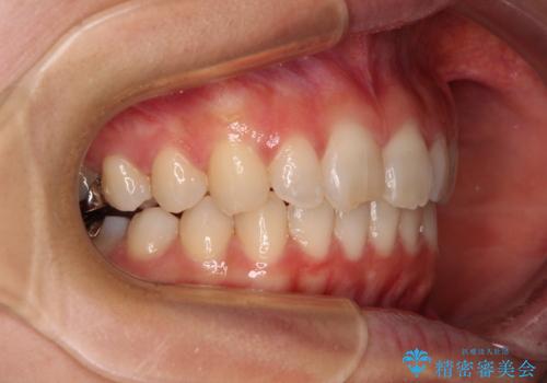 転勤予定がある インビザラインによる矯正治療の治療中