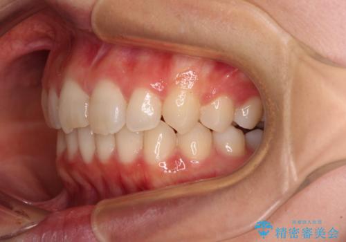 転勤予定がある インビザラインによる矯正治療の治療中