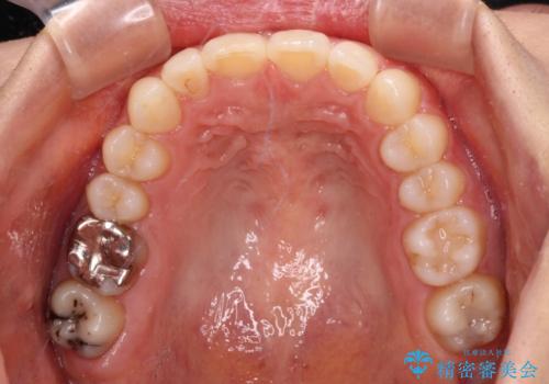 転勤予定がある インビザラインによる矯正治療の治療中