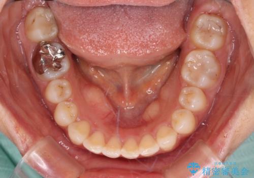 転勤予定がある インビザラインによる矯正治療の治療中
