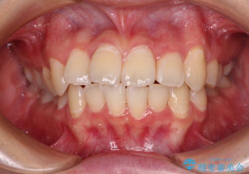 【モニター】八重歯と前歯のクロスバイト ワイヤーを併用しインビザラインで矯正治療の治療中