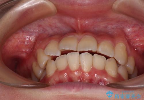 【モニター】八重歯と前歯のクロスバイト　ワイヤーを併用しインビザラインで矯正治療の治療中