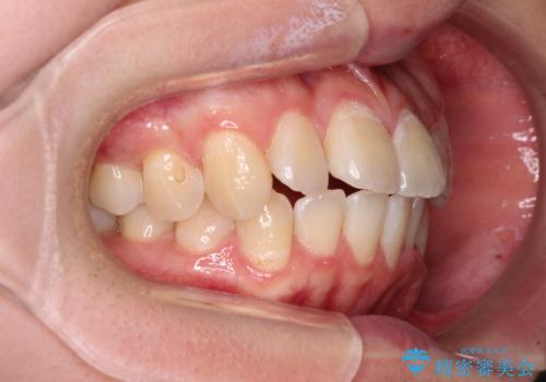 【モニター】八重歯と前歯のクロスバイト ワイヤーを併用しインビザラインで矯正治療の治療中