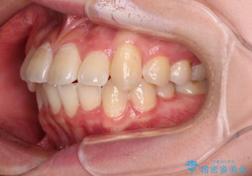 【モニター】八重歯と前歯のクロスバイト ワイヤーを併用しインビザラインで矯正治療の治療中