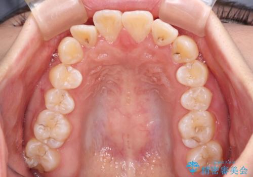 【モニター】八重歯と前歯のクロスバイト　ワイヤーを併用しインビザラインで矯正治療の治療中