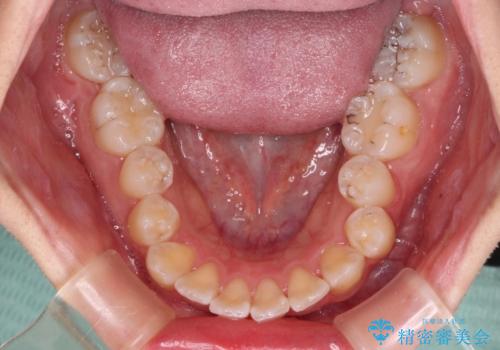 【モニター】八重歯と前歯のクロスバイト ワイヤーを併用しインビザラインで矯正治療の治療中