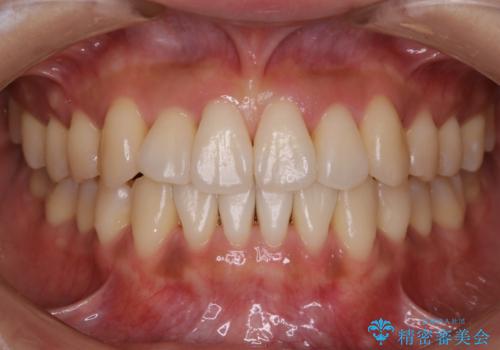 【非抜歯】左右の八重歯・前歯の反対咬合の改善 インビザライン
