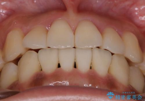 【非抜歯】左右の八重歯・前歯の反対咬合の改善 インビザラインの治療後