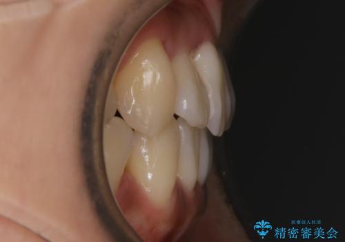 【非抜歯】左右の八重歯・前歯の反対咬合の改善 インビザラインの治療後