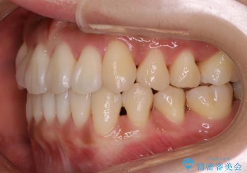 【非抜歯】左右の八重歯・前歯の反対咬合の改善 インビザラインの治療後