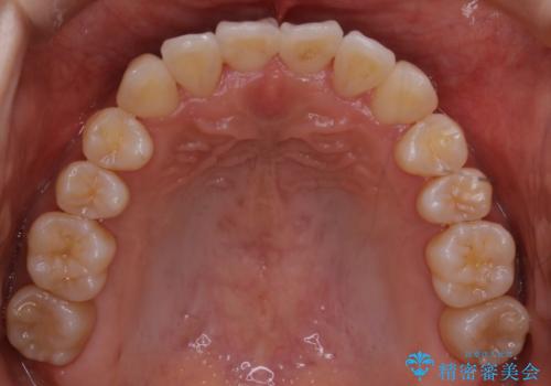 【非抜歯】左右の八重歯・前歯の反対咬合の改善 インビザラインの治療後