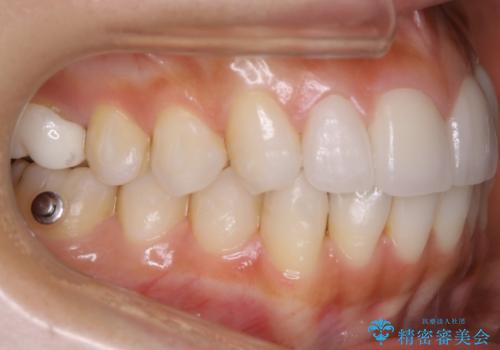 【非抜歯】噛み合わせを整えたい! インビザライン矯正の治療中