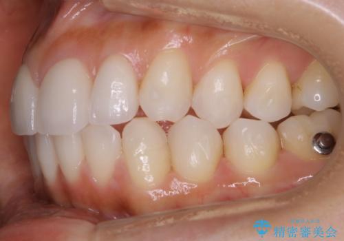 【非抜歯】噛み合わせを整えたい! インビザライン矯正の治療中