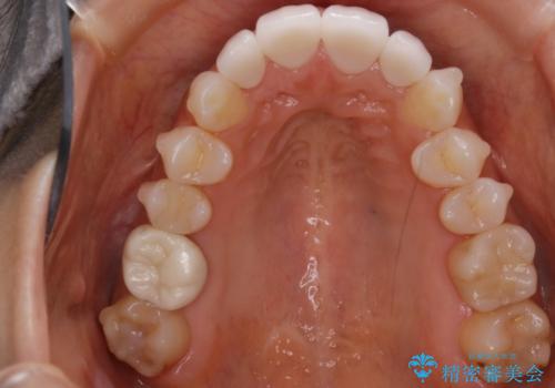 【非抜歯】噛み合わせを整えたい! インビザライン矯正の治療中