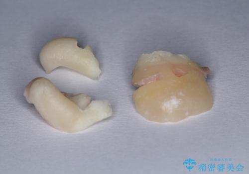 矯正前の親知らず抜歯(埋伏)の治療中