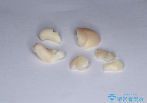 矯正前の親知らず抜歯(埋伏)の治療中