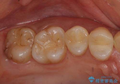 セラミック治療の治療後