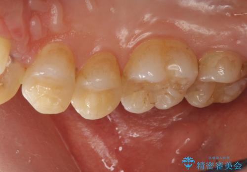 セラミック治療の治療後
