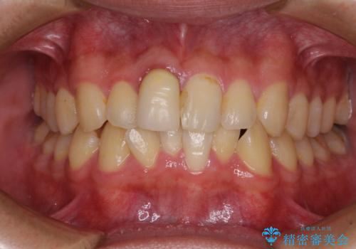 前歯のデコボコを治したい インビザライン矯正治療の症例 治療前