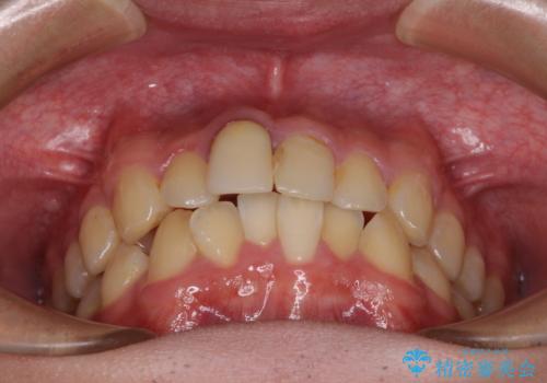 前歯のデコボコを治したい インビザライン矯正治療の治療前