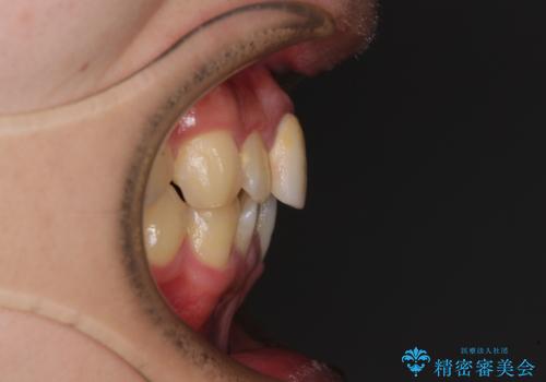 前歯のデコボコを治したい インビザライン矯正治療の治療前