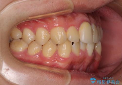前歯のデコボコを治したい インビザライン矯正治療の治療前