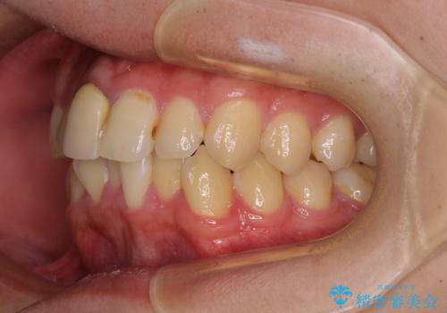 前歯のデコボコを治したい インビザライン矯正治療の治療前