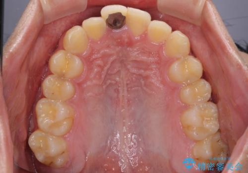 前歯のデコボコを治したい インビザライン矯正治療の治療前