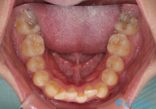 前歯のデコボコを治したい インビザライン矯正治療の治療前