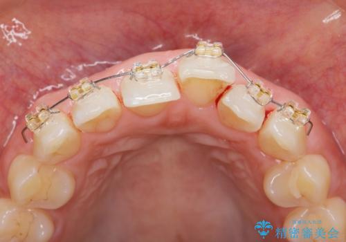 前歯のガタつきをきれいに マウスピース矯正治療の治療前