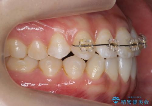 口元の印象が変わります。　引っ込んでいる前歯を出す治療の治療中