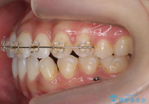 口元の印象が変わります。　引っ込んでいる前歯を出す治療の治療中