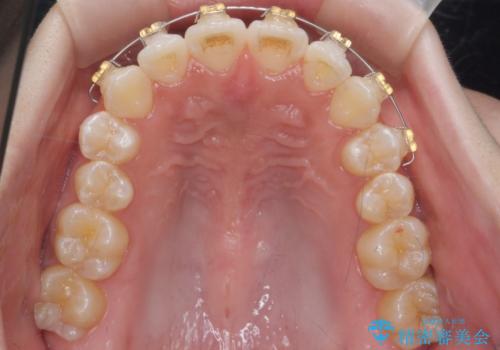 口元の印象が変わります。 引っ込んでいる前歯を出す治療の治療中