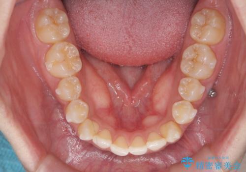 口元の印象が変わります。 引っ込んでいる前歯を出す治療の治療中