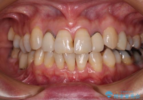 歯根が見えてしみる　歯肉移植による歯肉退縮の改善の症例 治療後
