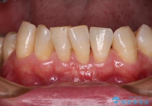 歯根が見えてしみる 歯肉移植による歯肉退縮の改善の治療後
