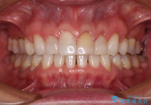 矯正治療の後戻り インビザライン・ライトでの再矯正の症例 治療後
