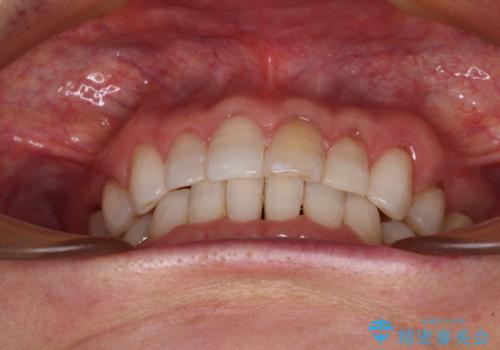 矯正治療の後戻り インビザライン・ライトでの再矯正の治療後